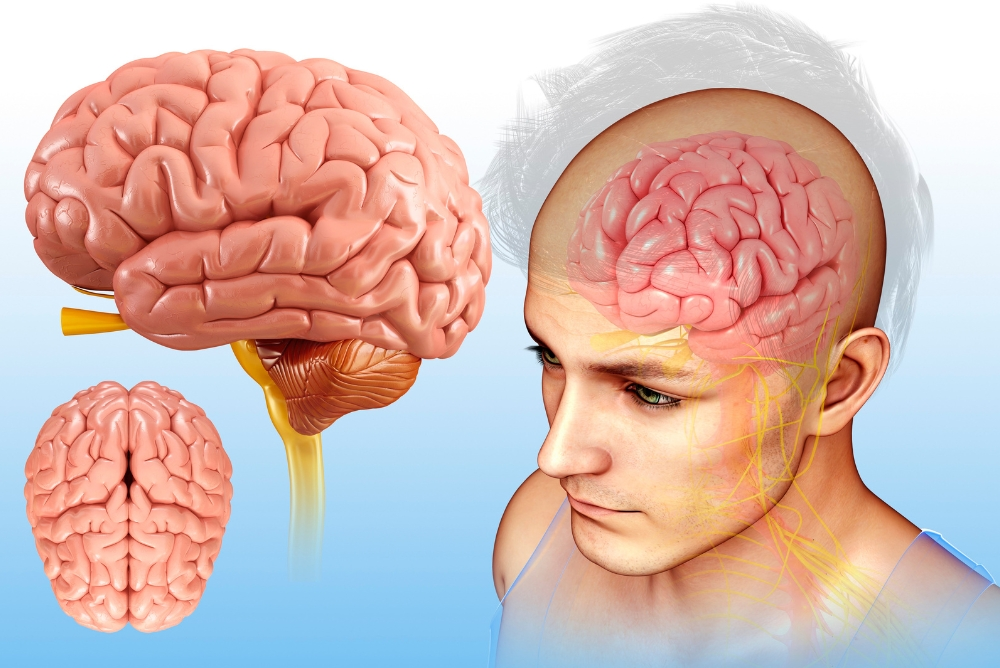 What Is Brain Hemorrhage and Why Immediate Treatment Matters